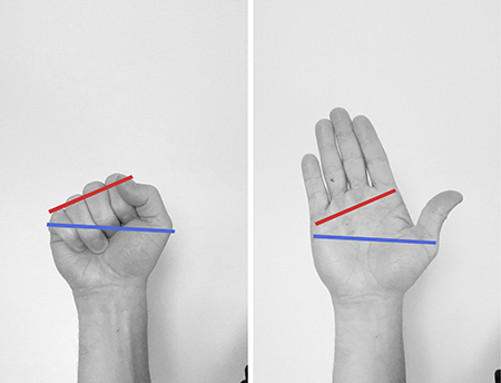 Brett is a ulnar deviation type of hand/wrist structure